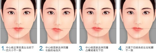 左右脸不对称 在韩国做整形要多少钱
