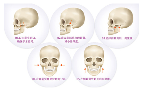 前颧骨填充术 打造饱满苹果肌