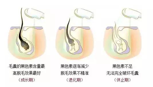 冰点激光脱毛原理过程