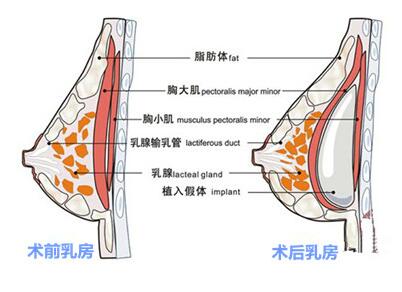 隆胸手术分析图