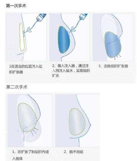 乳房重建整形术分析图