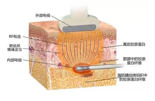 激光溶脂原理