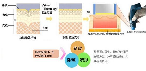 热玛吉的作用原理