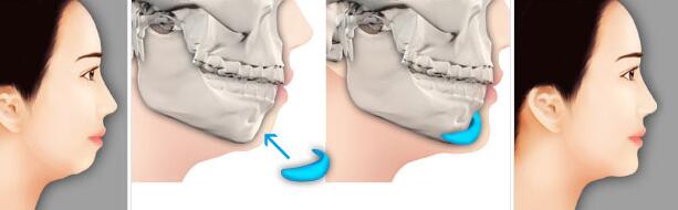 假体垫下巴示意图