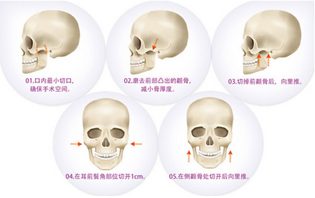 什么是颧骨整形