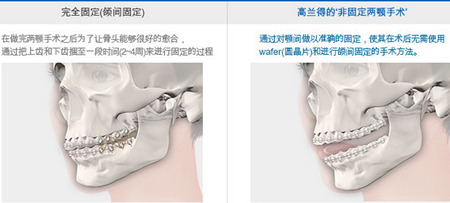 非固定双颚手术优势对比