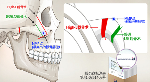 颧骨整形