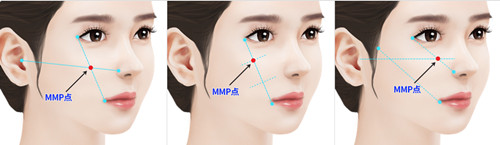 韩国颧骨整形颧骨的MMP点