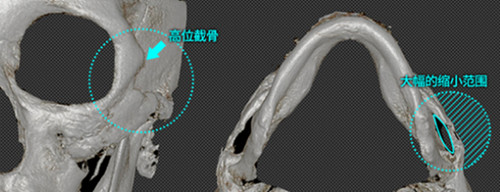 High-L颧骨缩小手术手术范围