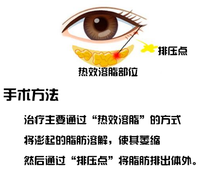 为什么溶脂可以去眼袋