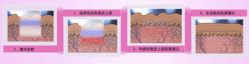 激光嫩肤过程