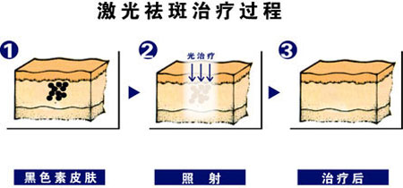 激光祛斑过程