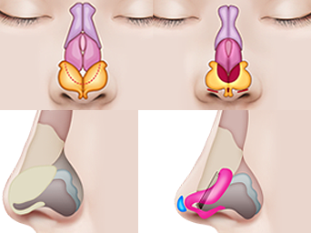 隆鼻鼻子结构图