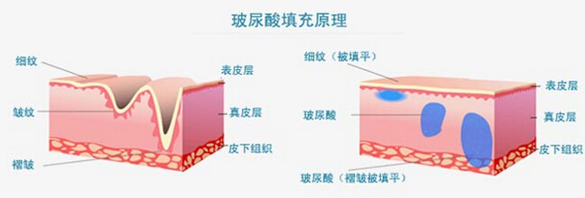 玻尿酸填充原理