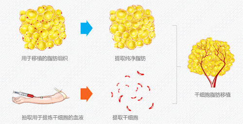 原辰整形外科Smsrt PReP2脂肪移植