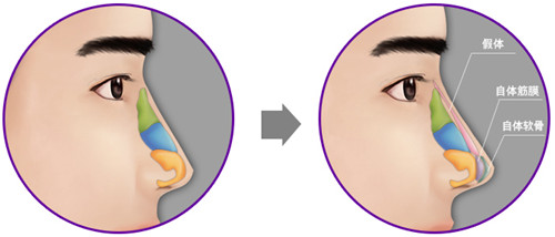 假体隆鼻层次对比