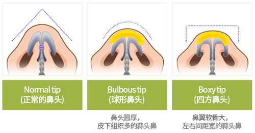 鼻头的三种情况