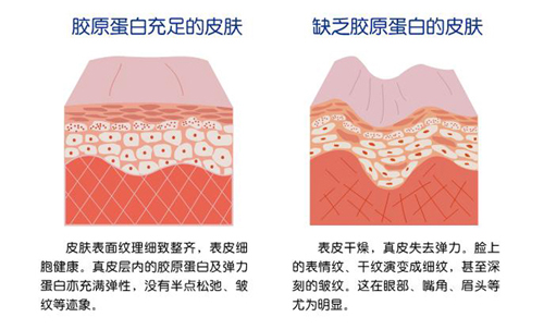 胶原蛋白充足皮肤和缺乏皮肤对比