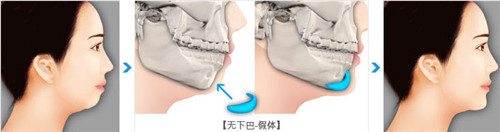 假体垫下巴过程