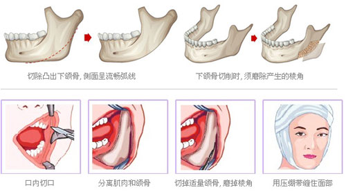 口内截除下颌角法示意图