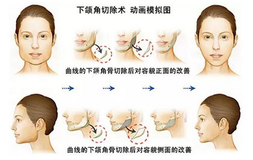 下颌角口外切口手术方法矫正法示意图