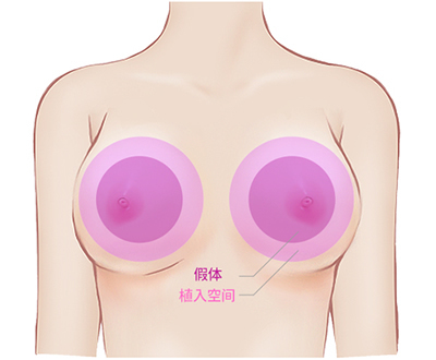 隆胸假体植入空间