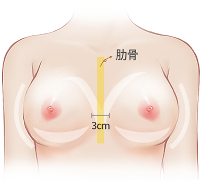 假体隆胸肋骨3厘米